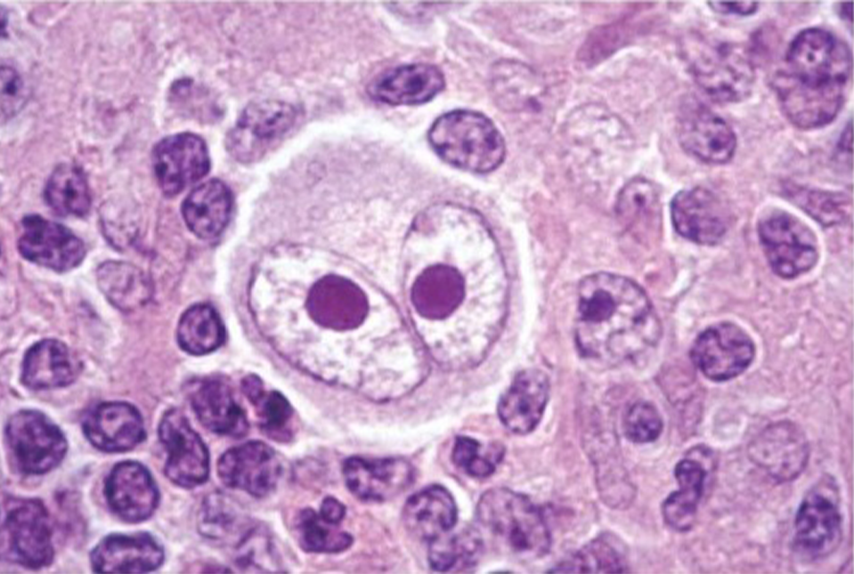 Hodgkin Lymphoma