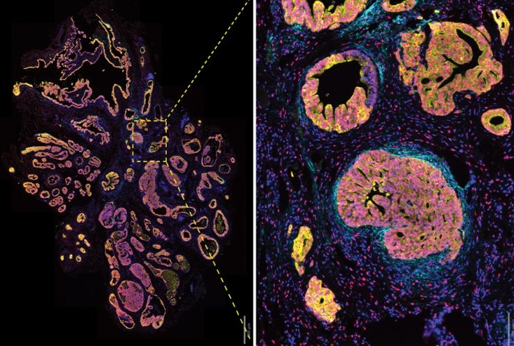 stromal cells from prostate cancer