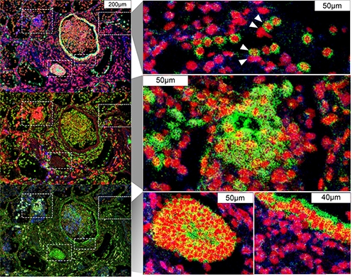 image showing spike protein, DNA, and immune cells in lung tissue from COVID-19 patients