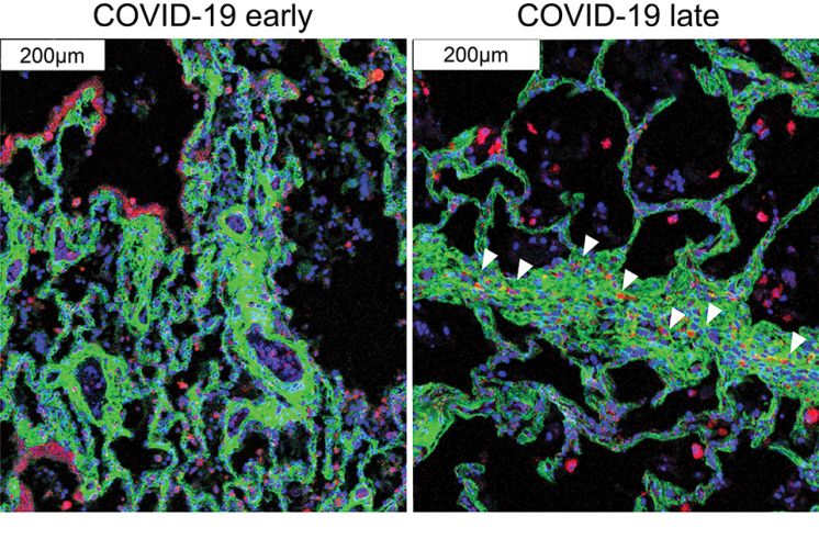 lung sections from early and late-stage COVID-19 patients showing fibrosis